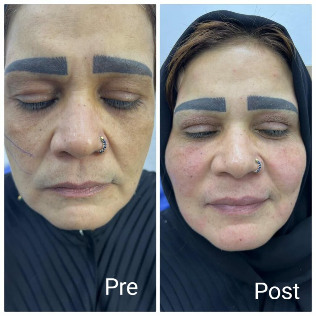 Tighten and lift the cheeks with cosmetic threads